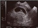 pregnancy-ultrasound-7-weeks.jpg