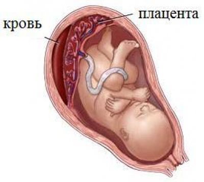 Что такое плацента у беременных женщин. Киста плаценты при беременности. Ребенок в плаценте матке.